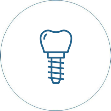 Zahnimplantate Wiesbaden